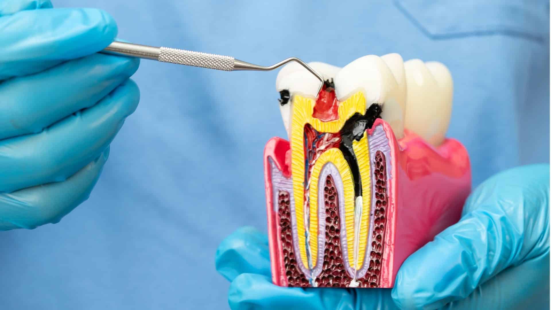 root canal treatment in Belper
